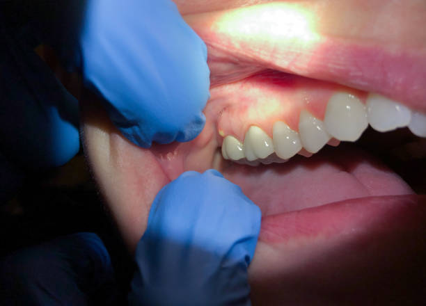Best Emergency Treatment for Dental Infections or Abscesses in Thonotosassa, FL